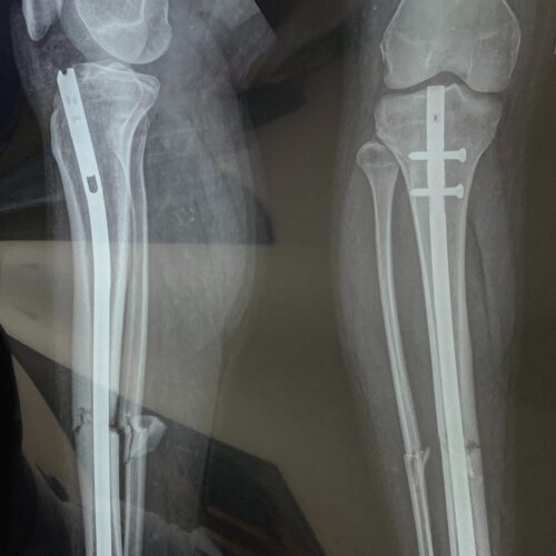 X-ray