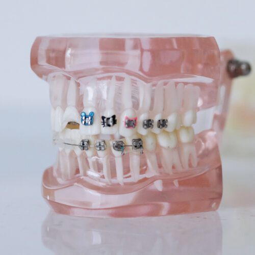 Model set of teeth with braces